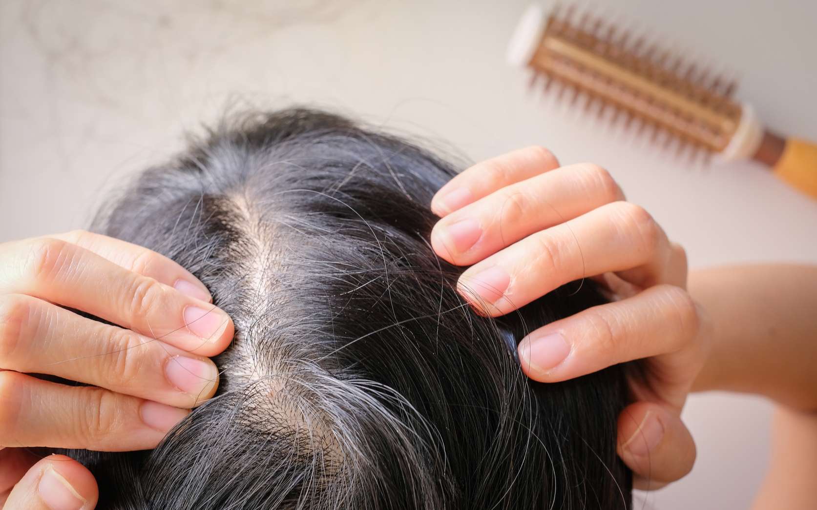 Chute de cheveux  comment y remédier